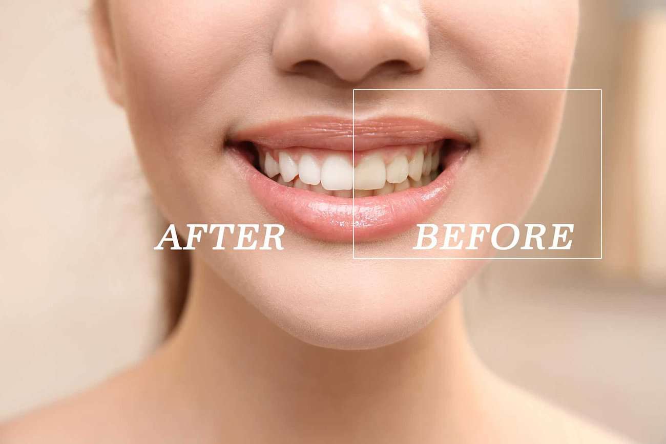 How Can You Maintain a Consistent Smile Shade with Crowns Salford?
