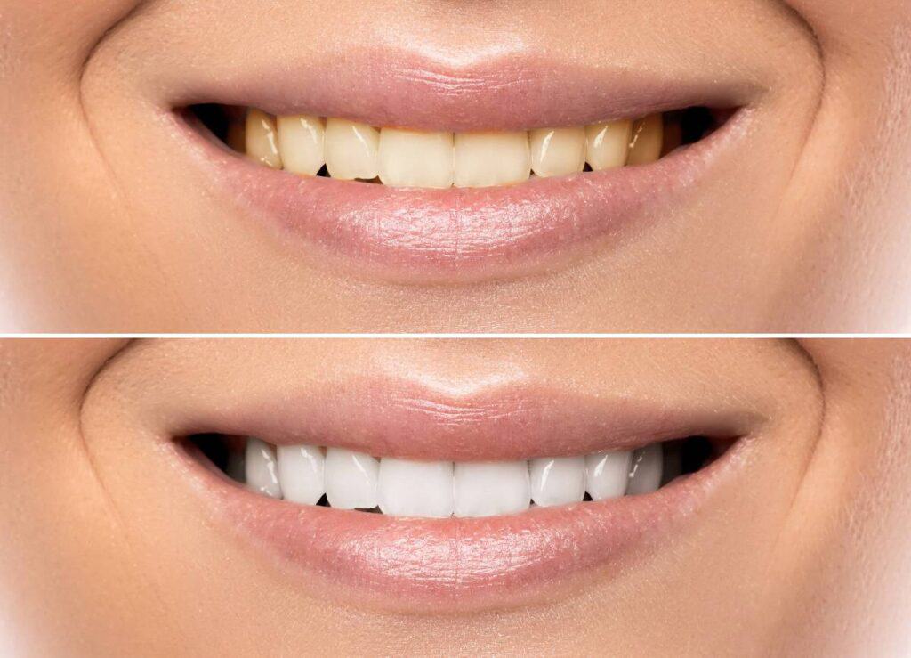 How Can You Protect Your White Smile as a Coffee Lover Salford?