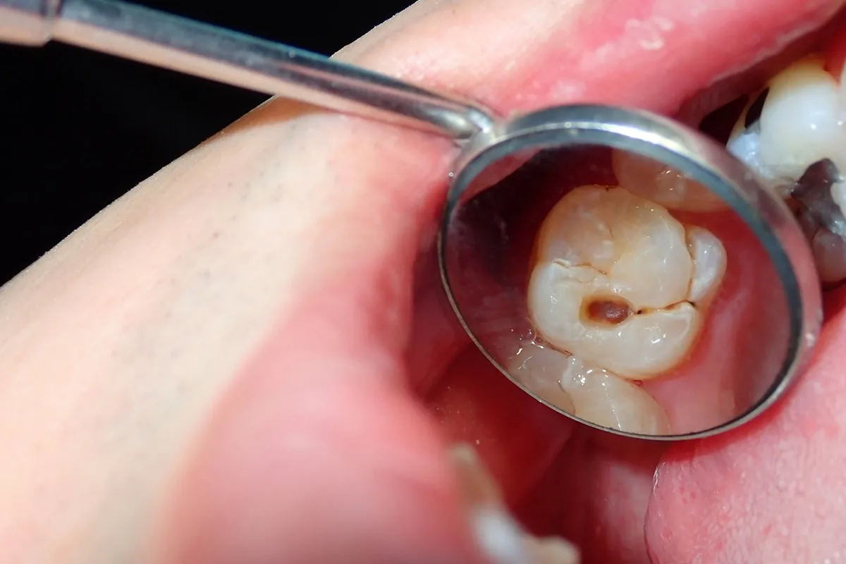 Why Do Teeth Crack? Common Causes to Know Salford