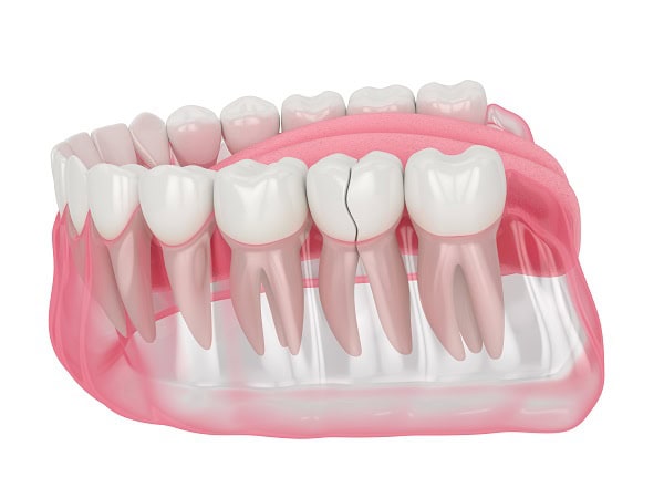 How Can You Manage Pain and Discomfort After a Root Canal Salford?