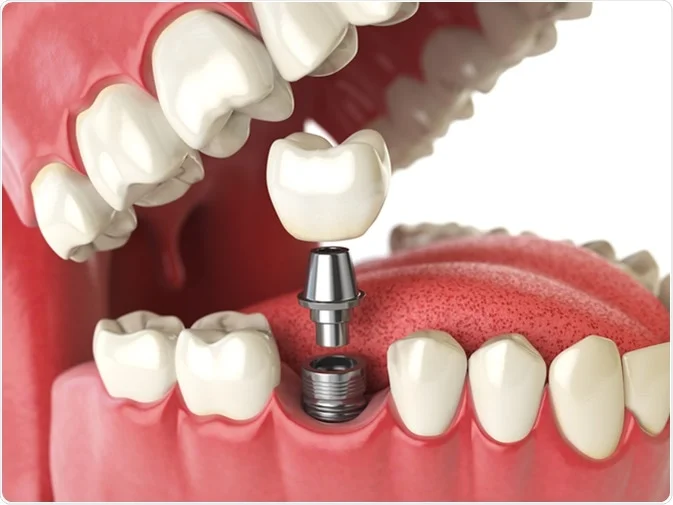 How Do I Decide Which Tooth Replacement Is Right for Me Salford?