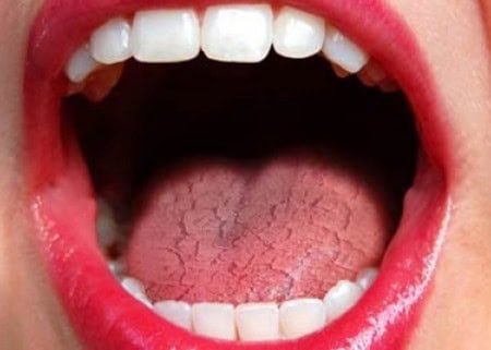 Common Causes of Dry Mouth (Xerostomia) Salford