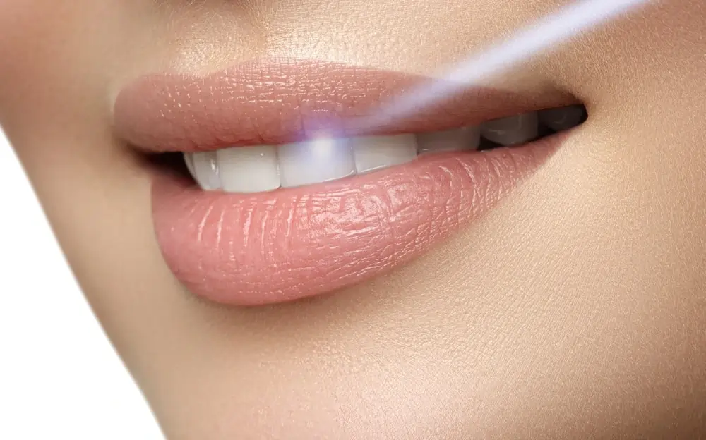 A Smarter Alternative: At-Home Laser Teeth Whitening Salford
