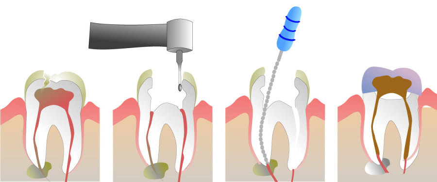 How Do You Properly Care for Your Teeth After a Root Canal Salford