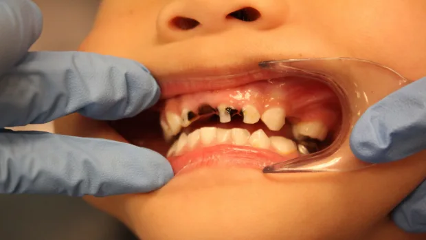 Which Foods and Drinks Cause the Most Damage to Young Smiles Salford?