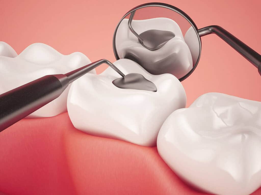 Fighting Cavities and Plaque Buildup Salford