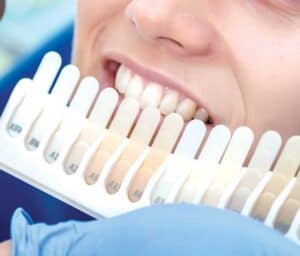 Ultimate Guide to Teeth Whitening with Natural Ingredients Salford