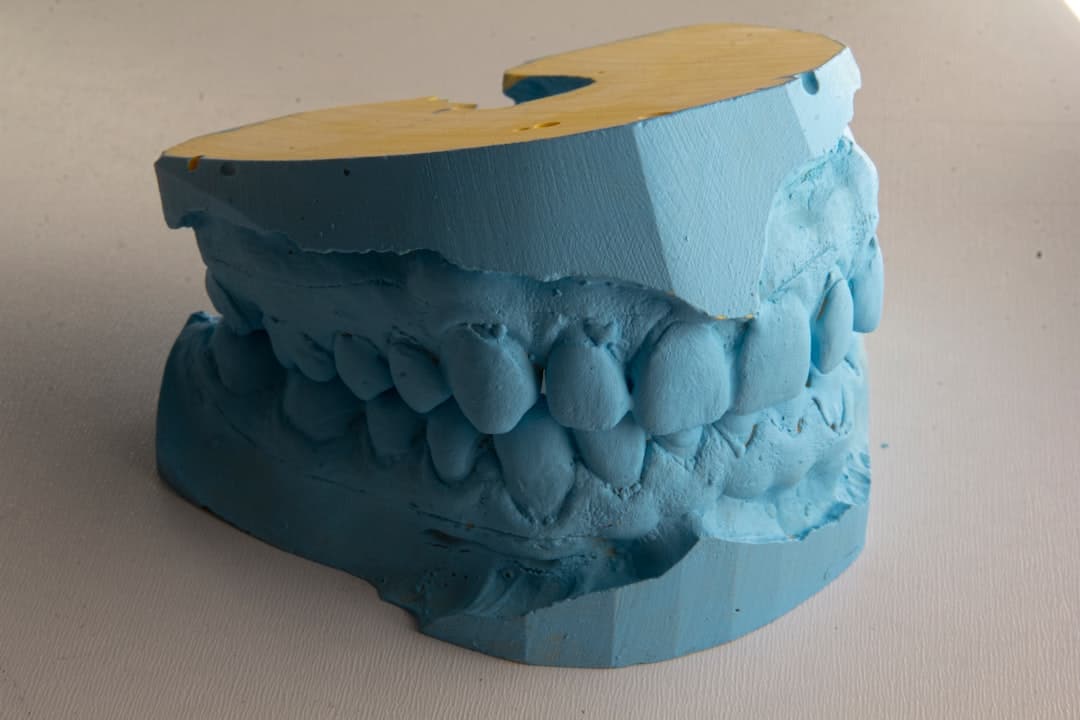 How Do Dental Implants Improve Jawbone Health and Oral Function Salford?