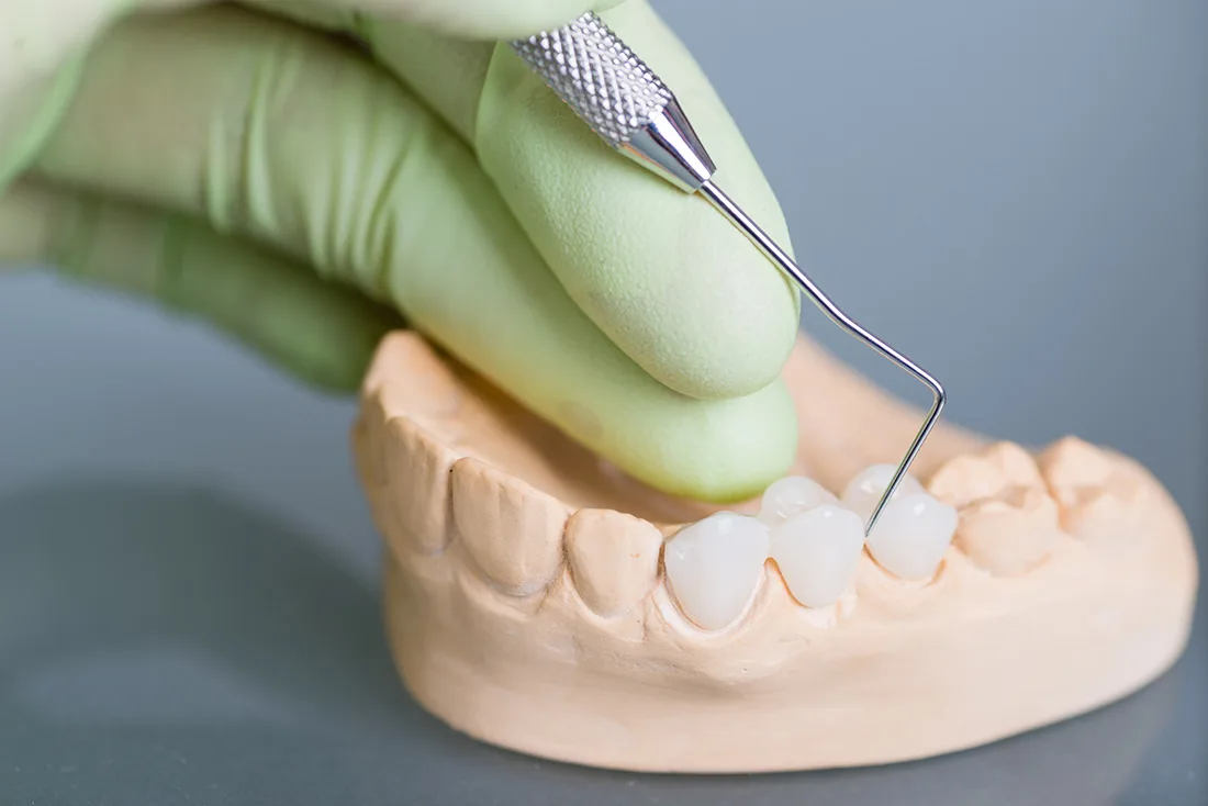What Are the Different Types of Dental Crowns Available Salford?