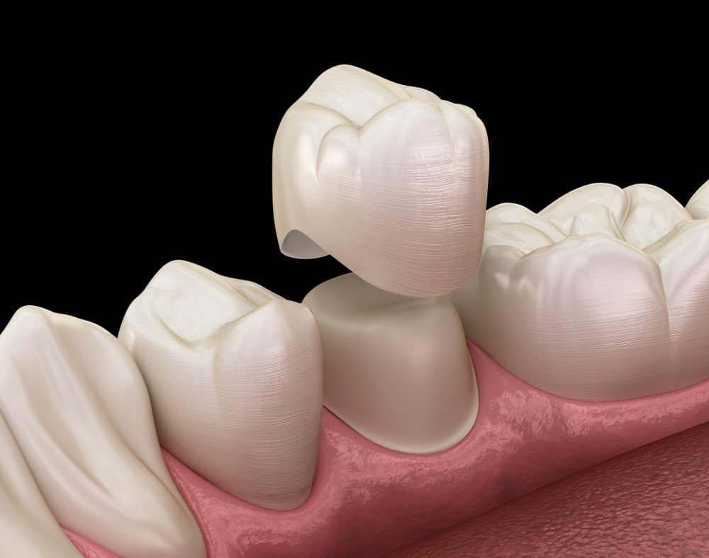 Teeth Whitening: Separating Facts from Fiction Salford