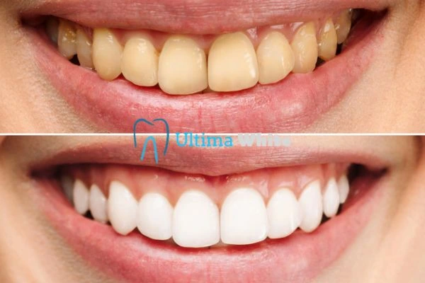Oral Care Tips for Current and Former Smokers Salford
