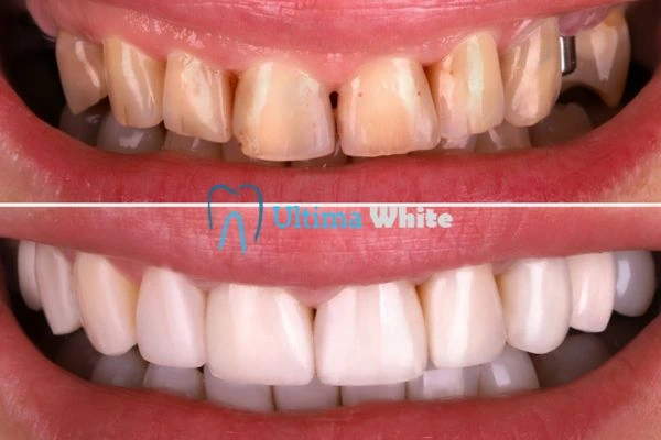What Makes Instant Teeth Whitening Treatments So Popular Salford?