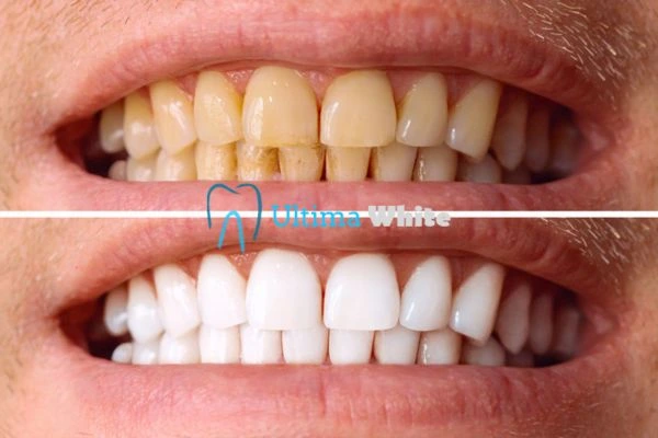 Stained Teeth and Persistent Bad Breath Salford
